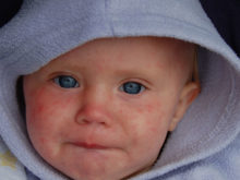 measles-baby